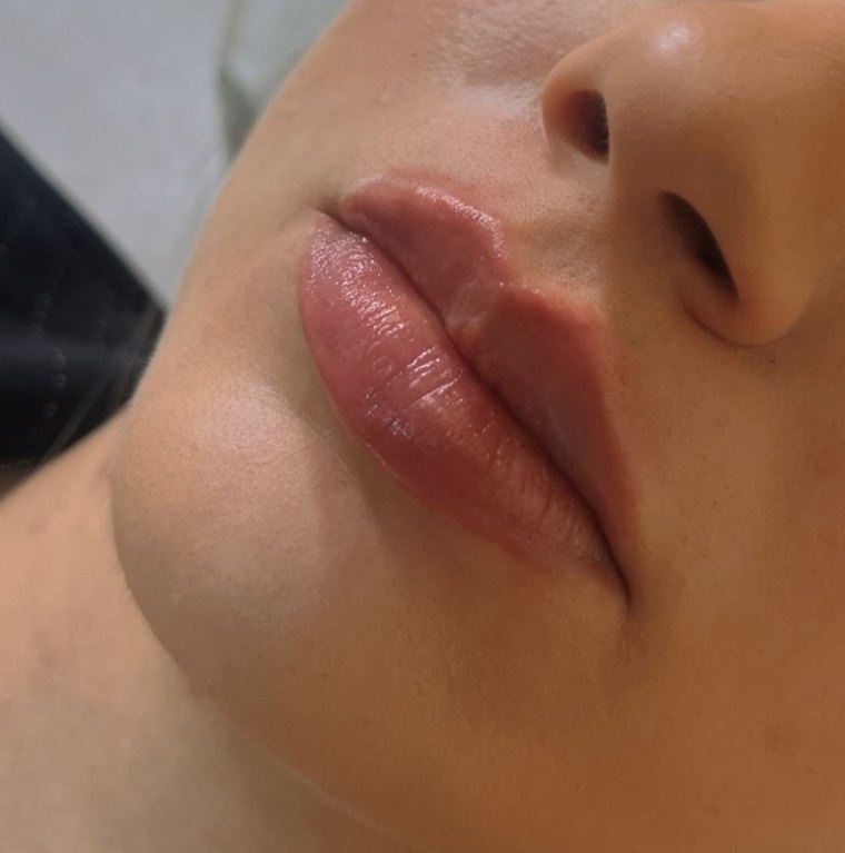 Resultado natural de preenchimento labial